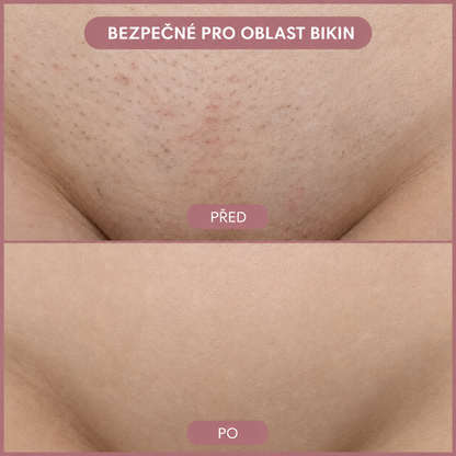 Teny IPL Laserový odstraňovač chloupků